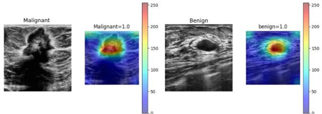 Computer-Aided System for Breast Cancer Lesion Segmentation and Classification Using Ultrasound Images